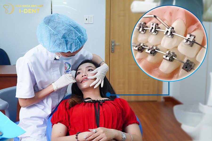 Dây cung niềng răng là khí cụ giúp dịch chuyển răng về đúng vị trí