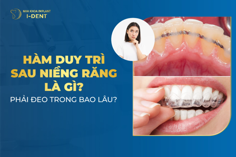 hàm duy trì sau niềng răng là gì