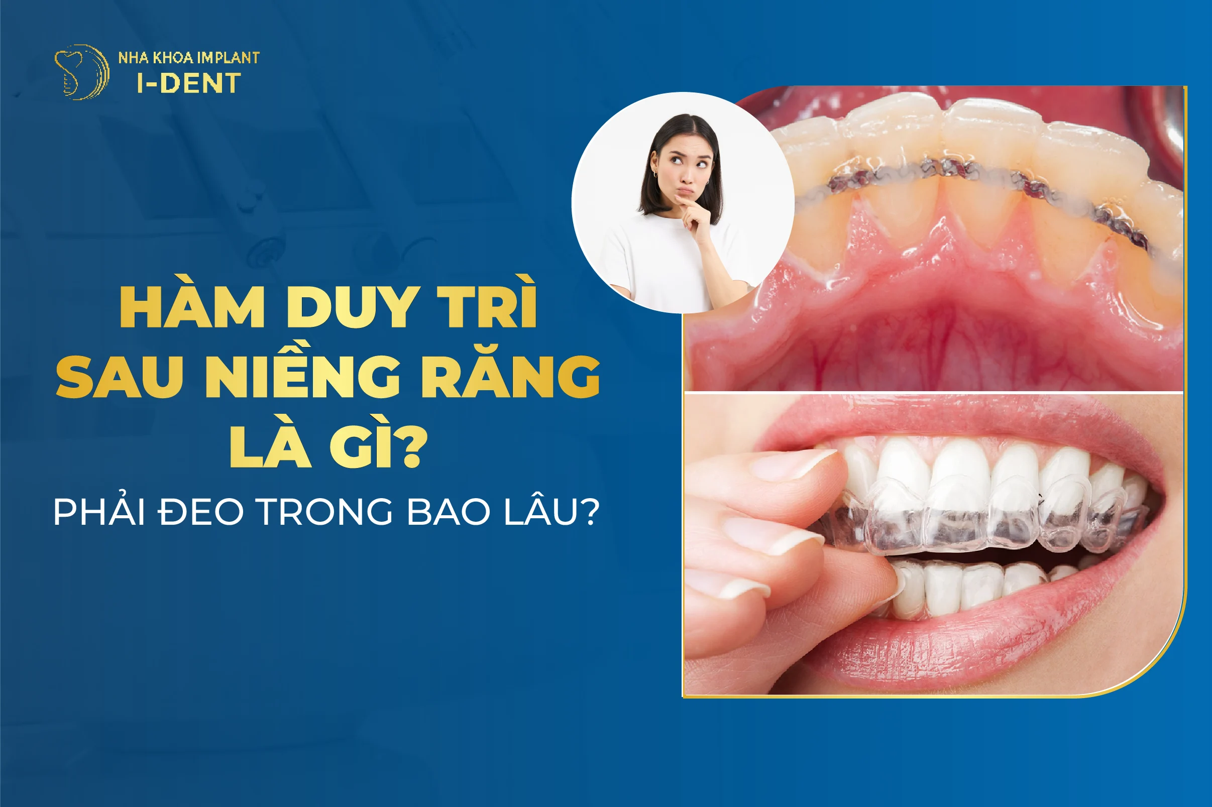 Hàm Duy Trì Sau Niềng Răng Là Gì? Phải Đeo Trong Bao Lâu?