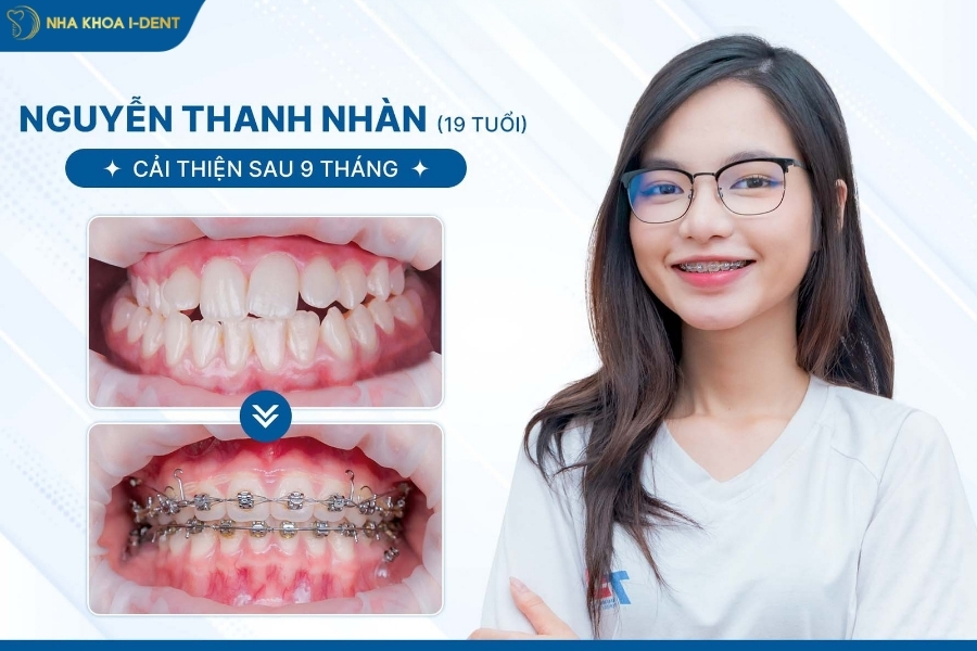 niềng răng bao lâu thì răng bắt đầu dịch chuyển - Nha khoa I-Dent