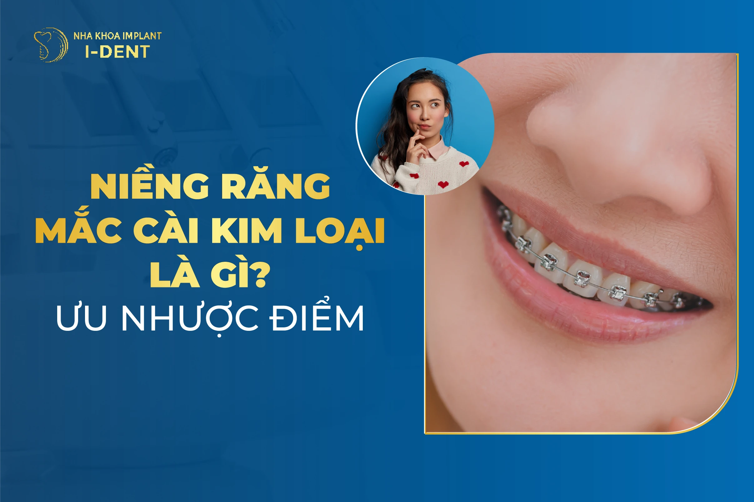Niềng Răng Mắc Cài Kim Loại Là Gì? Ưu nhược điểm mắc cài kim loại