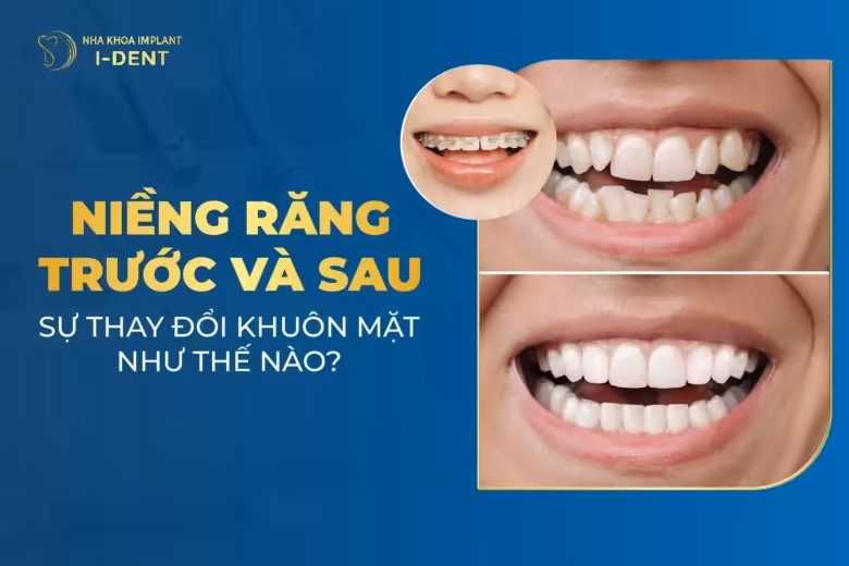 Trước Và Sau Khi Niềng Răng Khuôn Mặt Thay Đổi Như Thế Nào?