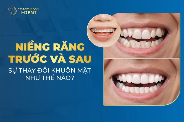 Sự Thay Đổi Trước Và Sau Khi Niềng Răng – Nha Khoa IDent