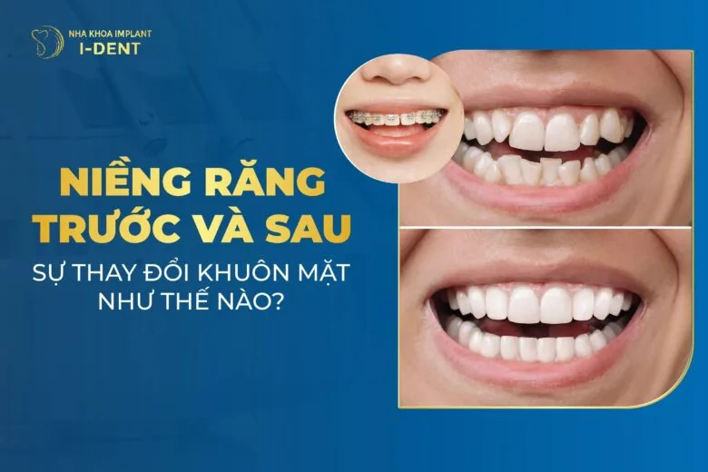 Trước Và Sau Khi Niềng Răng Khuôn Mặt Thay Đổi Như Thế Nào?