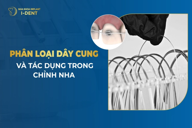 Phân Loại Dây Cung Và Tác Dụng Trong Chỉnh Nha