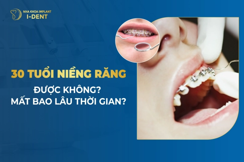 30 Tuổi Niềng Răng Được Không? Mất Bao Lâu Thời Gian?