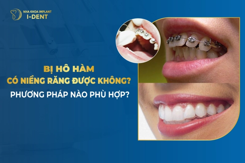 Bị Hô Hàm Trên Có Niềng Răng Được Không? Phương Pháp Nào Phù Hợp?