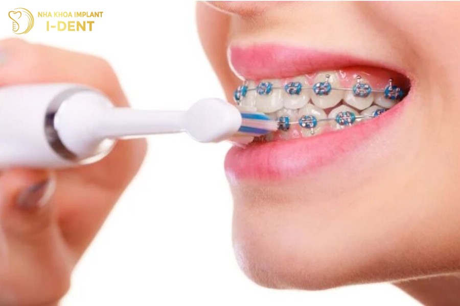 Cần vệ sinh răng miệng đúng cách trong quá trình niềng răng