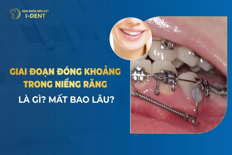 Giai-Doan-Dong-Khoang-Trong-Nieng-Rang-La-Gi-Mat-Bao-Lau