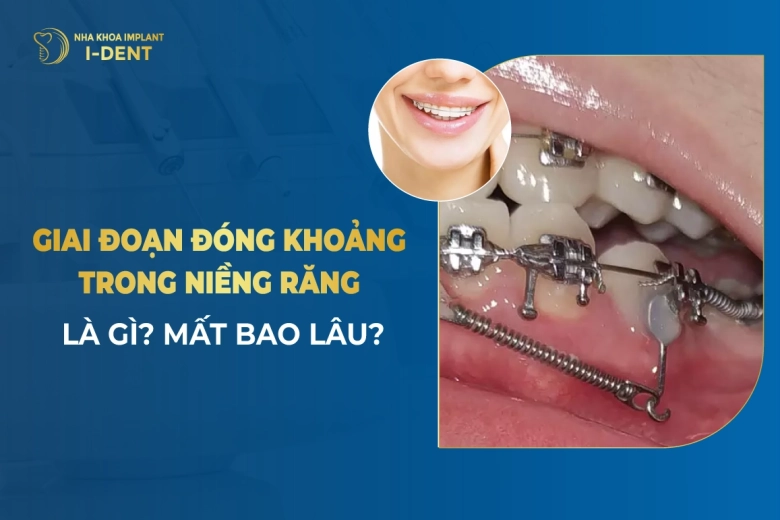 Giai Đoạn Đóng Khoảng Trong Niềng Răng Là Gì? Mất Bao Lâu?