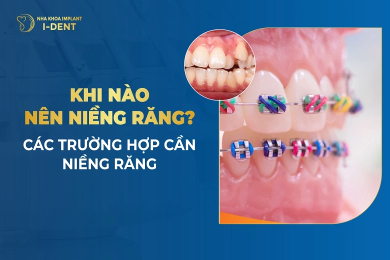 Khi-Nao-Nen-Nieng-Rang-Cac-Truong-Hop-Can-Nieng-Rang