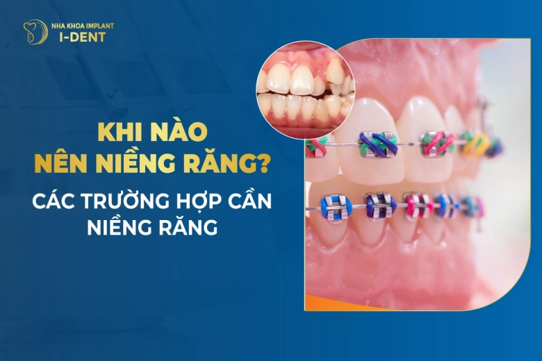 Khi Nào Nên Niềng Răng? Các Trường Hợp Cần Niềng Răng