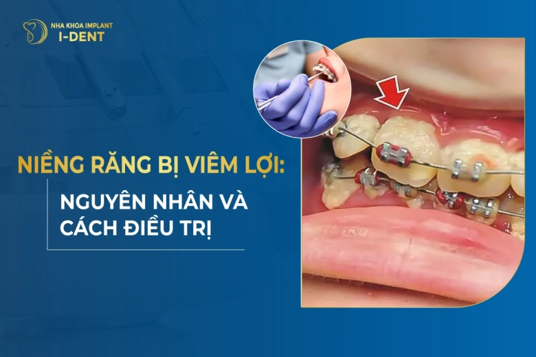 Niềng Răng Bị Viêm Lợi: Nguyên Nhân Và Cách Điều Trị