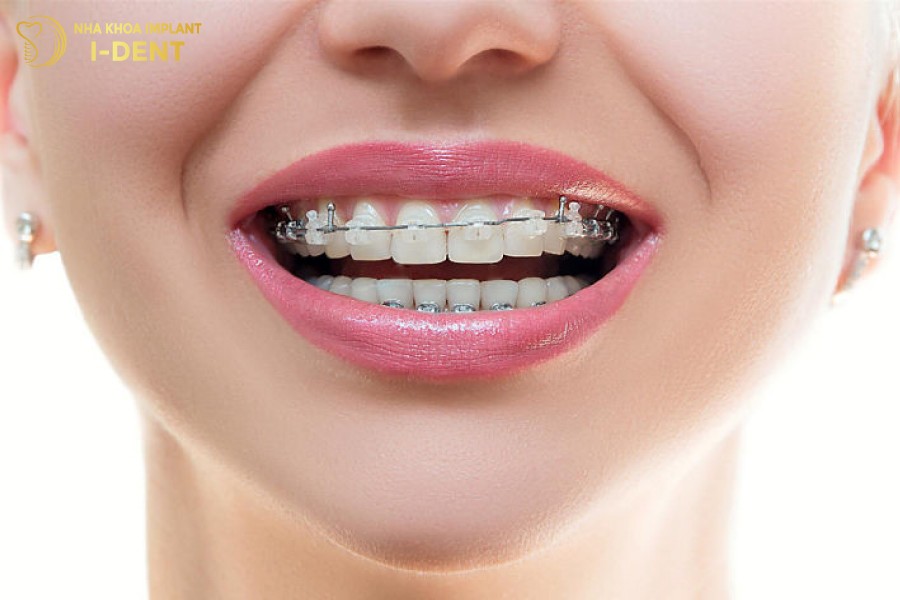 Niềng răng đem lại sự thay đổi tích cực cho khuôn mặt