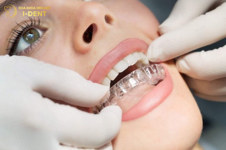Niềng răng nhựa còn gọi là niềng răng trong suốt