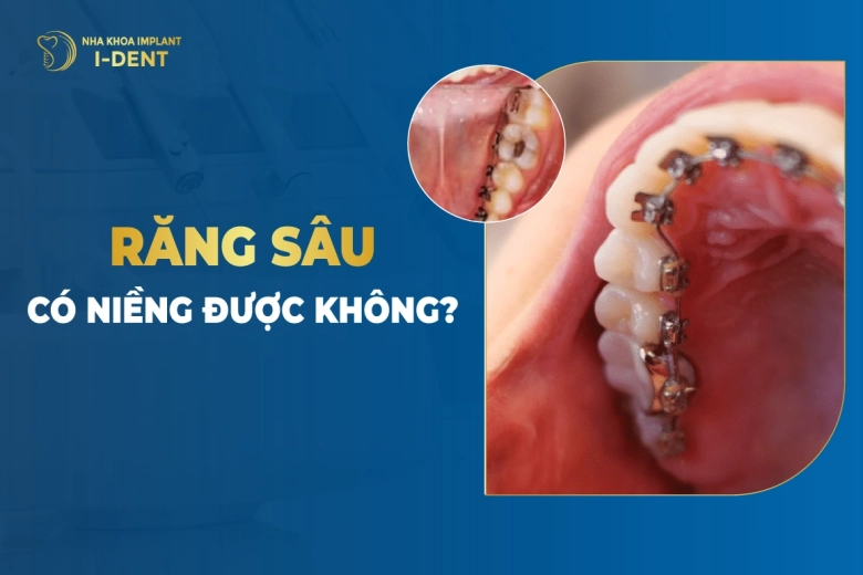 Răng Sâu Có Niềng Được Không?