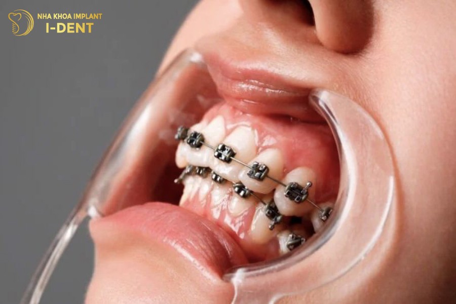 Răng có thể vẫn bị hô sau niềng do quá trình điều trị sai cách