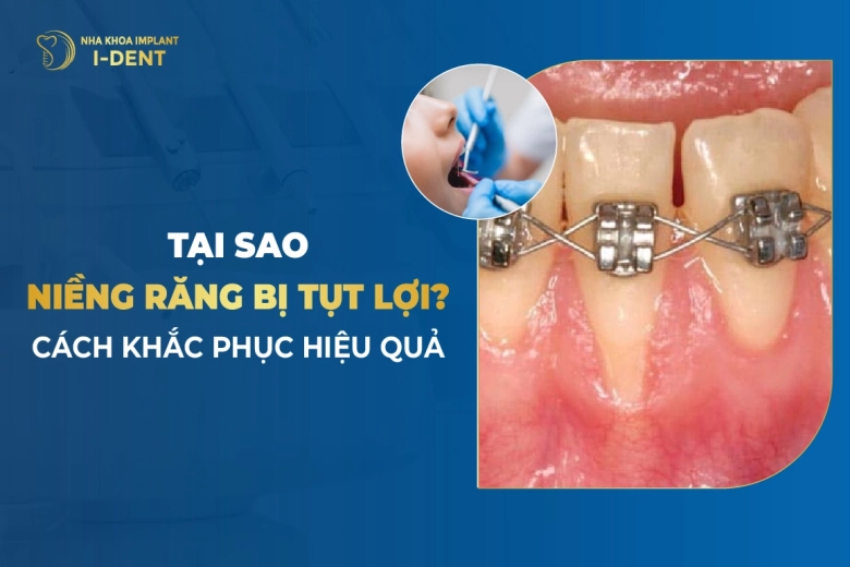 tụt lợi khi niềng răng
