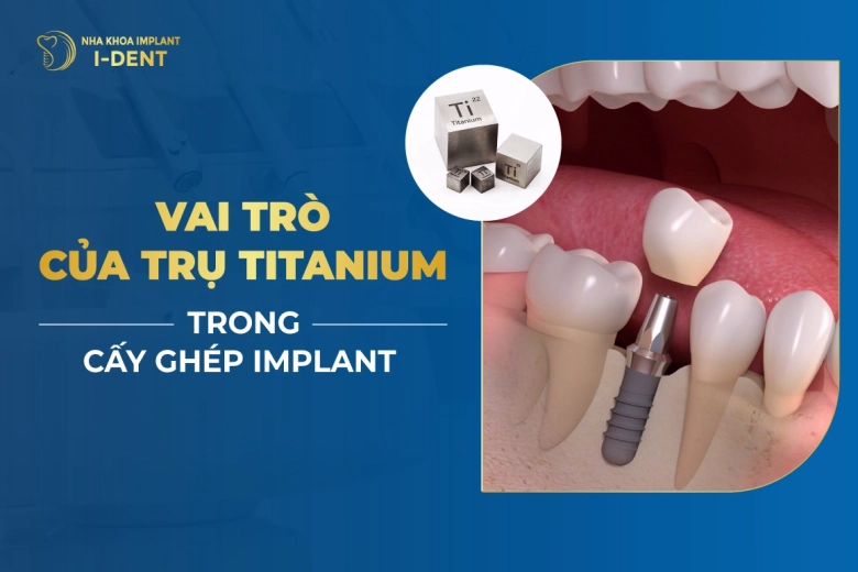 Vai-Tro-Cua-Tru-Titanium-Trong-Cay-Ghep-Implant