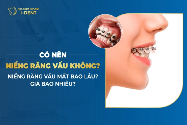 Niềng Răng Vẩu Mất Bao Lâu? Giá Bao Nhiêu Tiền?