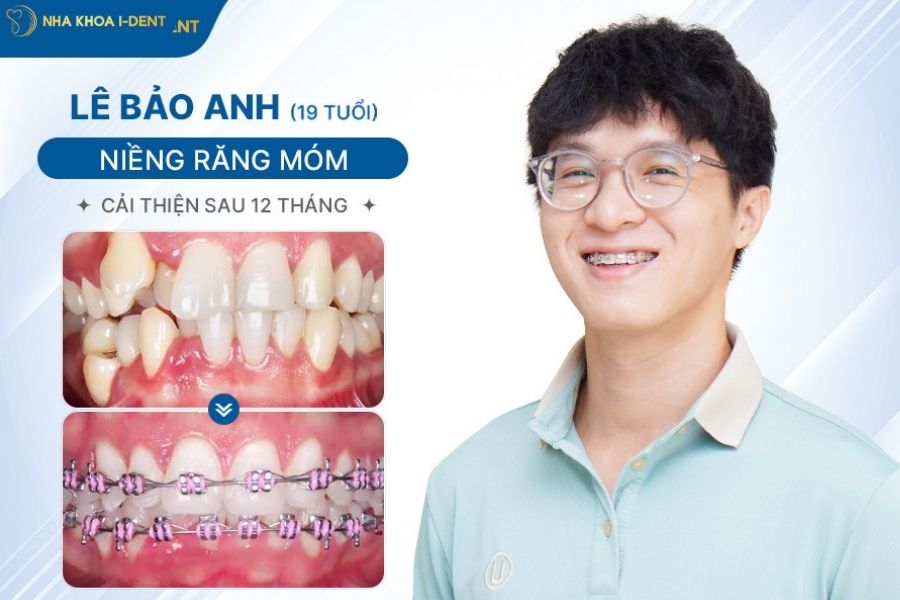 giai đoạn đóng khoảng trong niềng răng - Nha khoa I-Dent