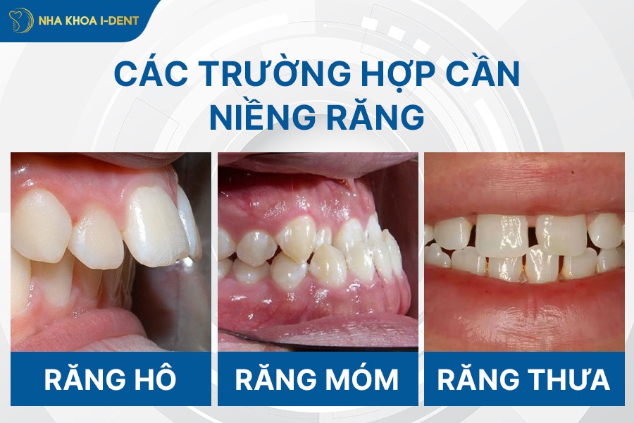 khi nao nen nieng rang