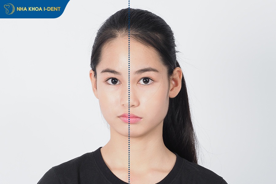 mặt lệch niềng răng