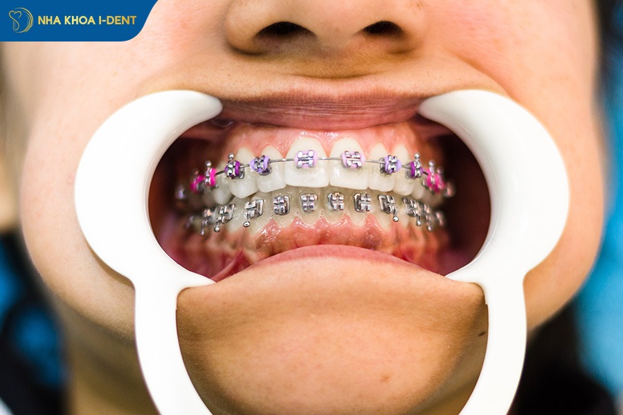 niềng răng bị lung lay
