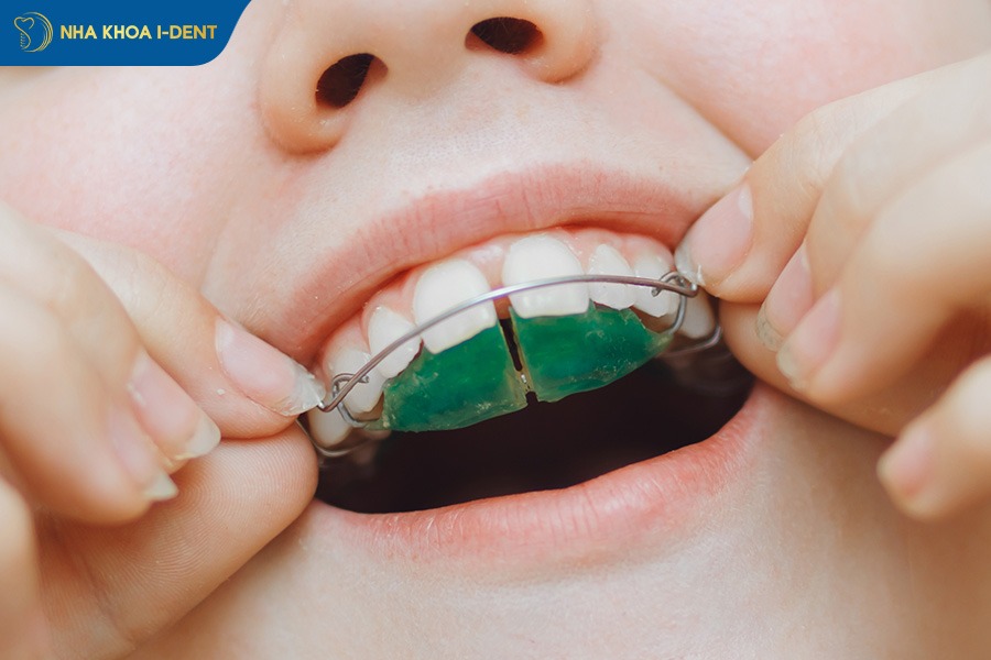 niềng răng có bị chạy lại không