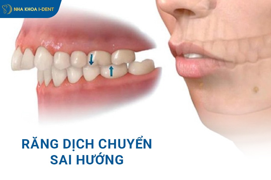 niềng răng có bị hô lại không