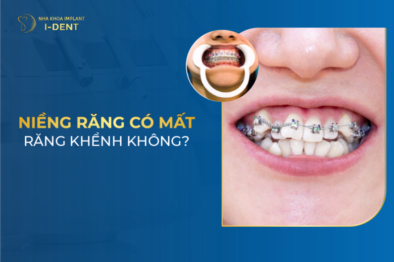 Niềng răng có giữ được răng khểnh không
