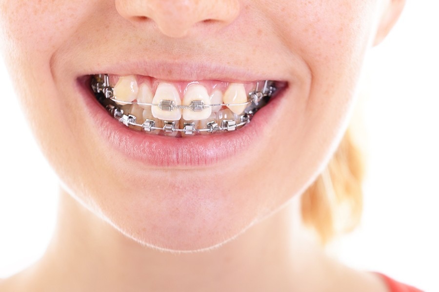 Niềng răng khểnh bằng phương pháp niềng răng mắc cài kim loại