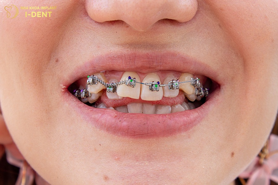 Bác sĩ không khuyển khích giữ răng khểnh khi niềng