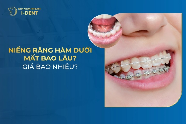 Chỉ Niềng Răng Hàm Dưới Có Được Không? Mất Bao Lâu?