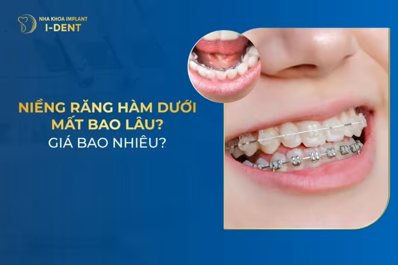 Chỉ Niềng Răng Hàm Dưới Có Được Không? Mất Bao Lâu?