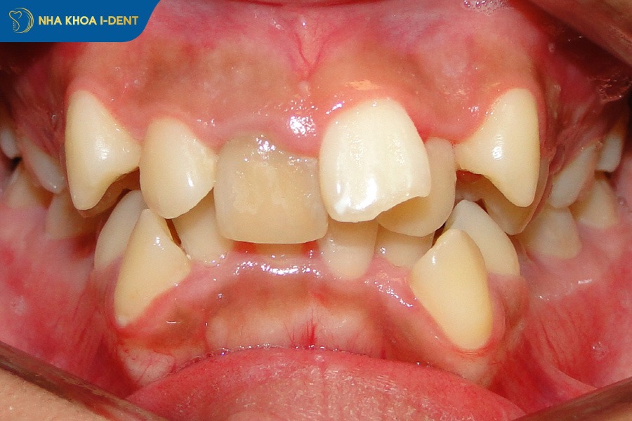 niềng răng khi nào