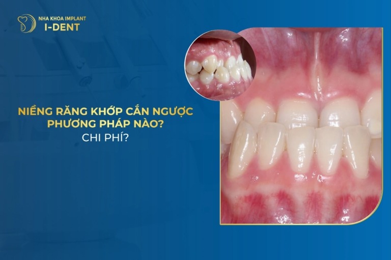 Niềng Răng Khớp Cắn Ngược Bao Lâu? Giá Bao Nhiêu?