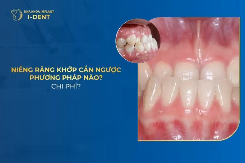 Niềng Răng Khớp Cắn Ngược Bao Lâu? Giá Bao Nhiêu?