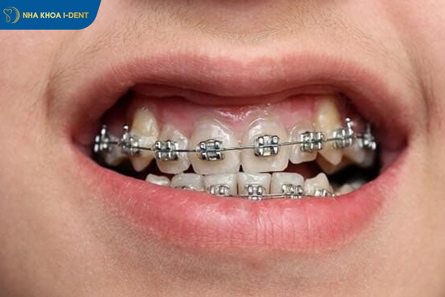 niềng răng khớp cắn ngược bao lâu