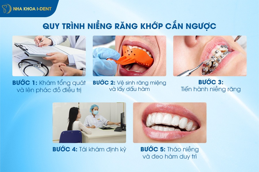 niềng răng khớp cắn ngược bao nhiêu tiền