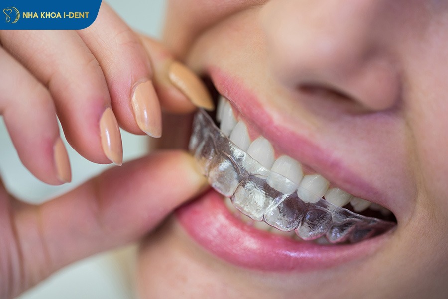 niềng răng khớp cắn ngược giá bao nhiêu