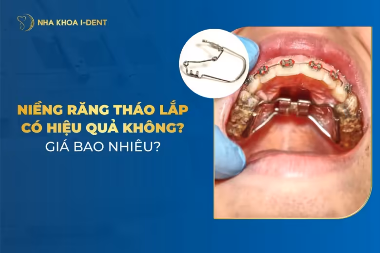niềng răng tháo lắp