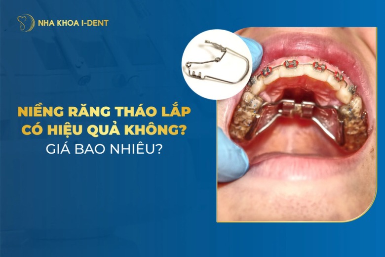 Niềng Răng Tháo Lắp Có Hiệu Quả Không? Giá Bao Nhiêu?