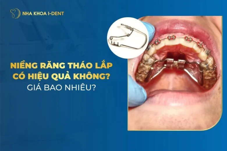 niềng răng tháo lắp