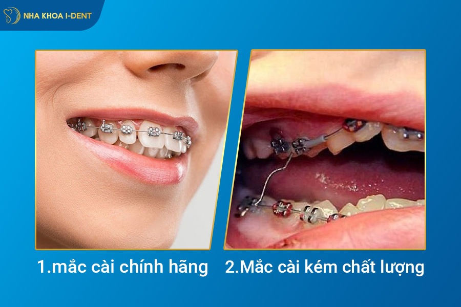 niềng răng xong có bị hô lại không