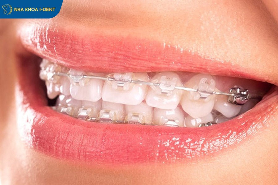 niềng răng xong vẫn hô