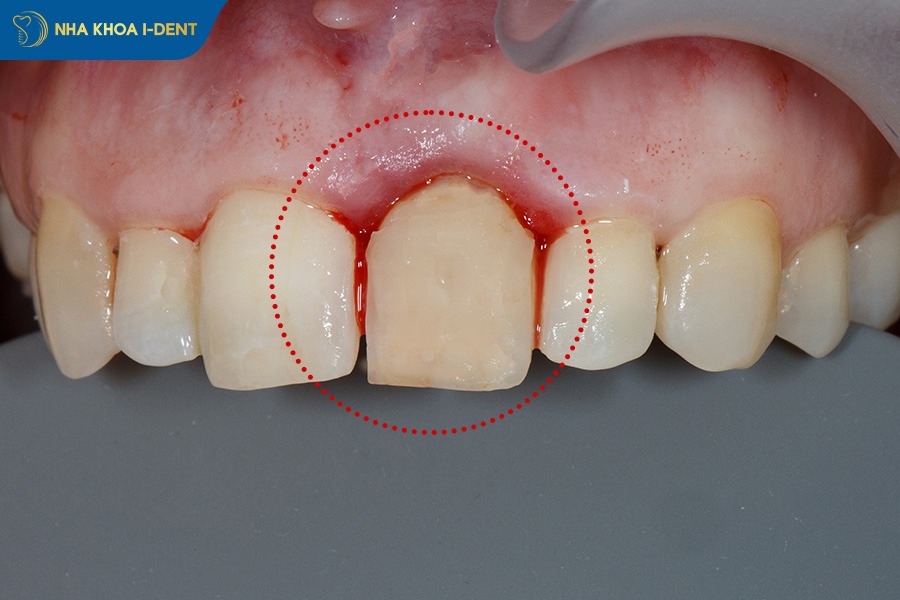 răng bị lung lay khi niềng