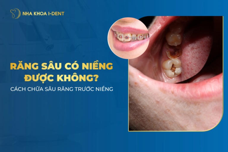 răng sâu có niềng được không