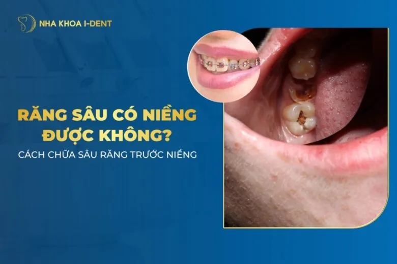 răng sâu có niềng được không