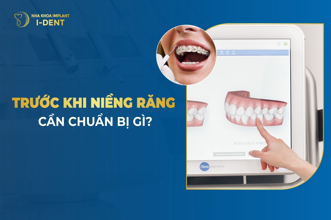 Trước Khi Niềng Răng Cần Chuẩn Bị Gì?